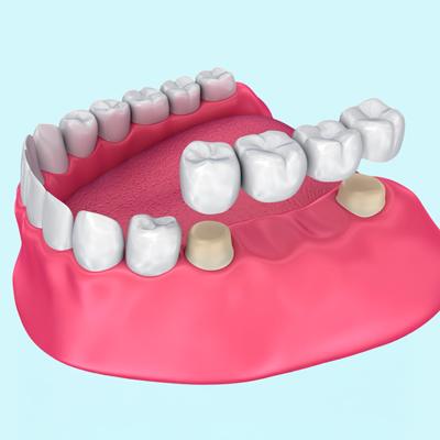 Bridges - Professional teeth whitening in North Edmonton