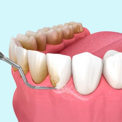 Cleaning-&-Scaling Professional teeth whitening in North Edmonton