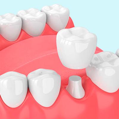 Dental-Crowns - Professional teeth whitening in North Edmonton