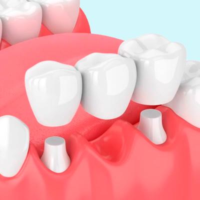 Dental-Implants Professional teeth whitening in North Edmonton