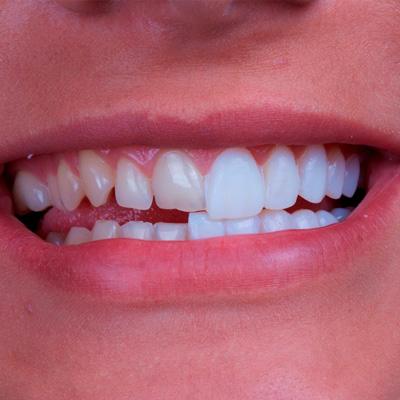 Dental-Veneers-Professional teeth whitening in North Edmonton