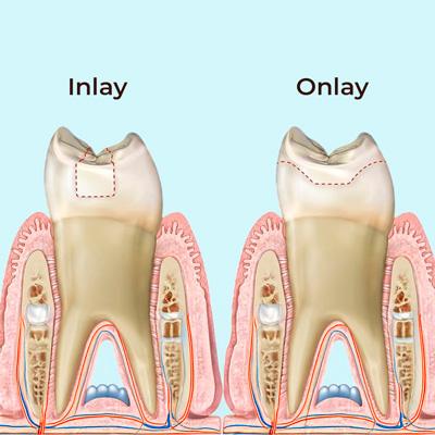 INLAYS-ONLAYS- Professional teeth whitening in North Edmonton