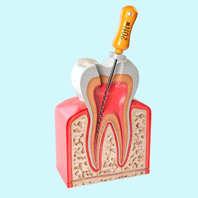 Root Canal - Custom dentures in Edmonton at affordable prices
