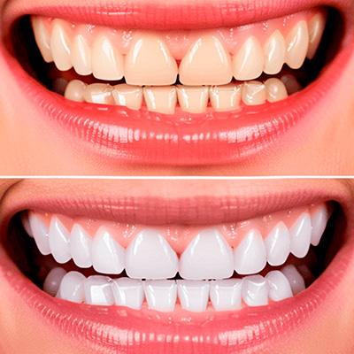 Teeth-Whitening Professional teeth whitening in North Edmonton