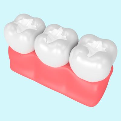 sealants Professional teeth whitening in North Edmonton